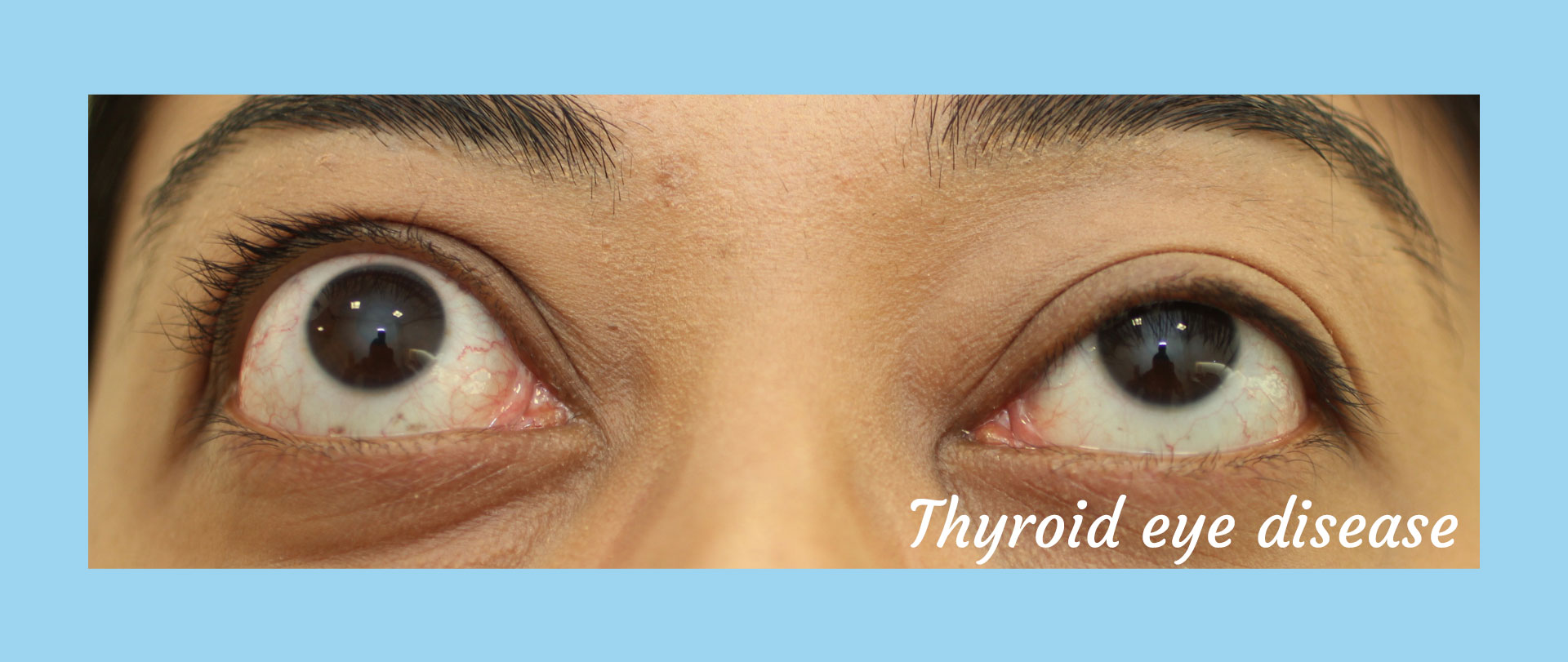 Homepage Thyroid Eye Disease