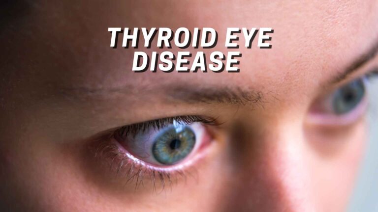 thyroid-eye-disease-thyroid-eye-disease