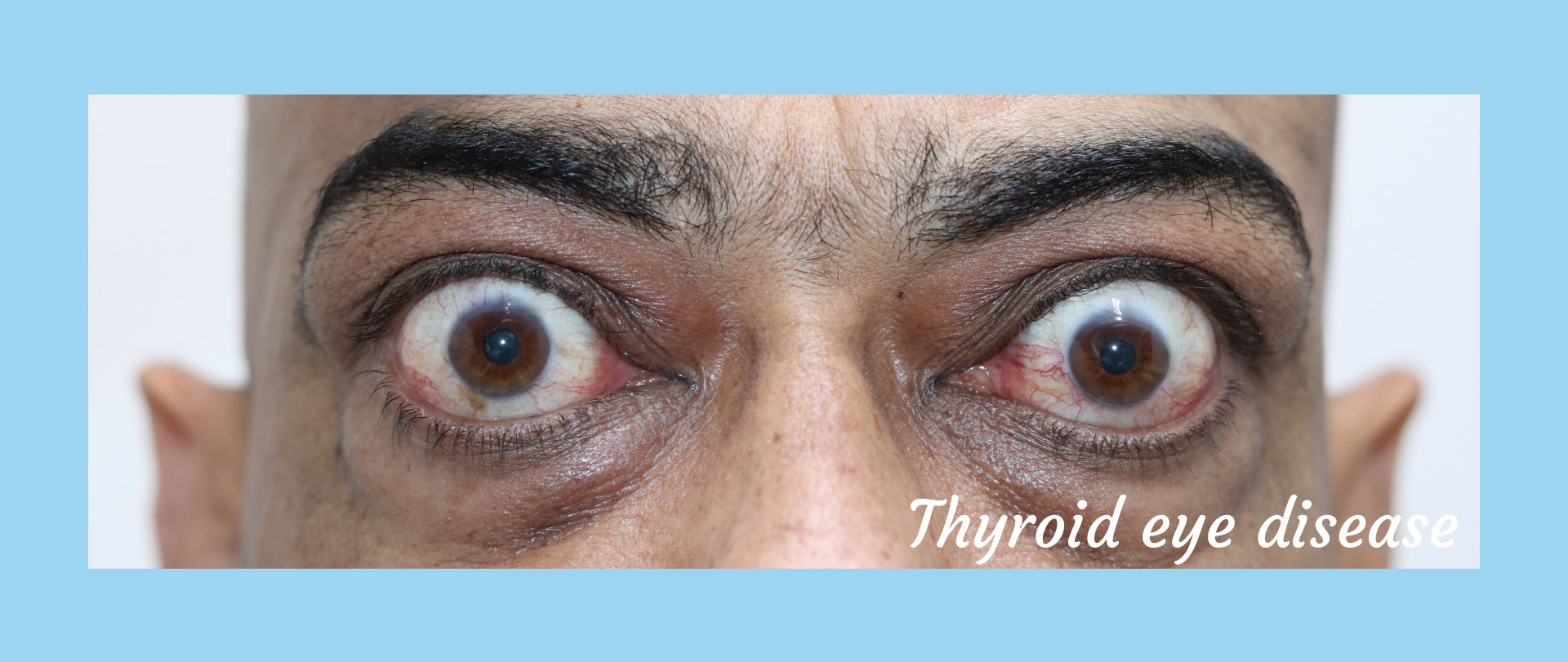 Homepage - Thyroid Eye Disease