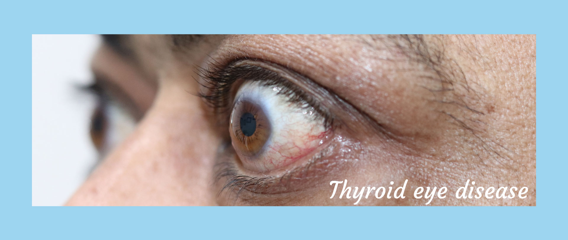 Homepage - Thyroid Eye Disease