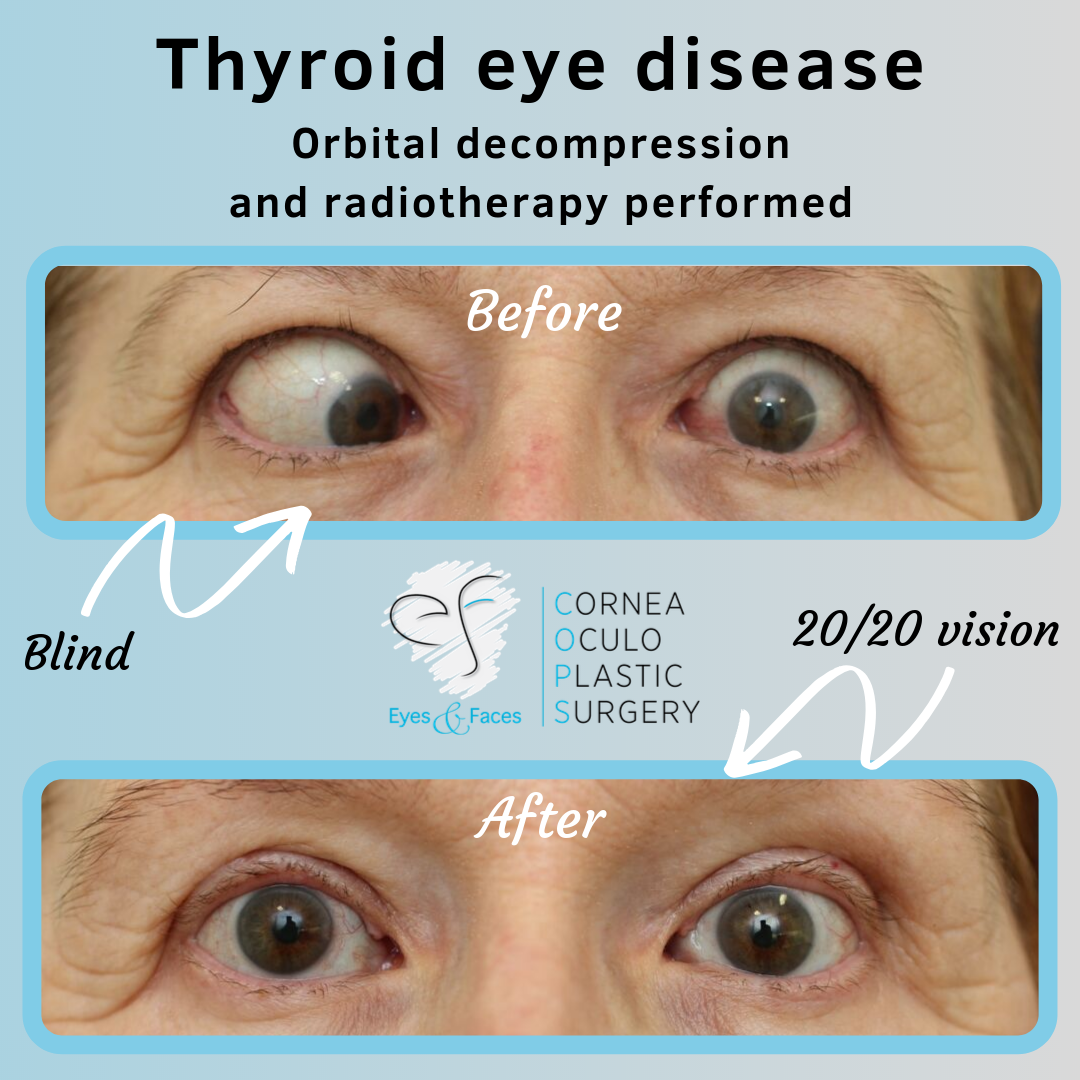 Thyroid eye disease - from blind to 20/20 vision.