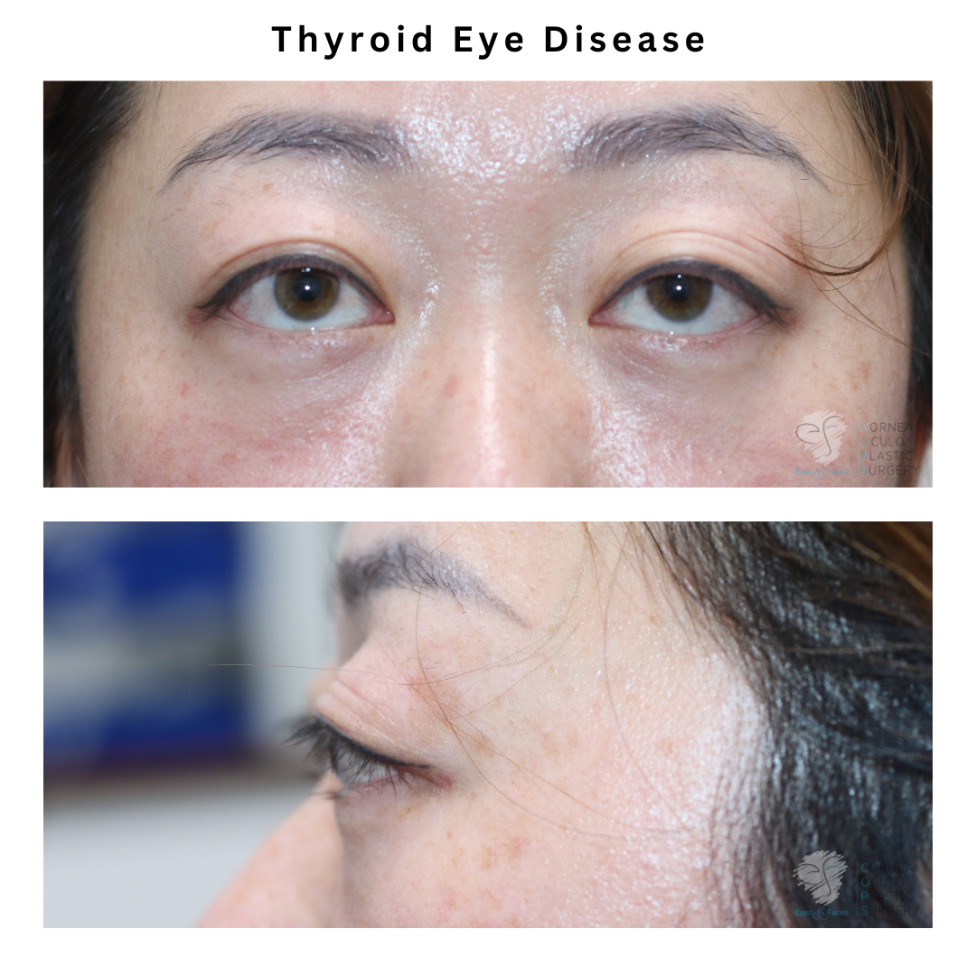 Initially seeking cosmetic surgery for upper eyelids, it turns out the real issue is thyroid eye disease. It’s important to identify the underlying cause for the best treatment plan.